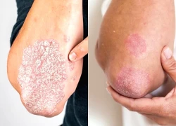 Nhận biết các biểu hiện tổn thương viêm khớp vảy nến