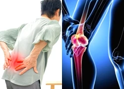 Xương "kêu cứu" vì thói quen cứ nhức mỏi lại uống thuốc giảm đau