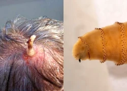 Ấu trùng có thể sống ký sinh trên cơ thể người đang áp sát nước Mỹ