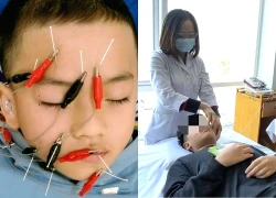 Nguyên nhân khiến bé 11 tuổi liệt dây thần kinh phải nhập viện