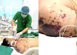 Ăn thịt lợn ở đám cỗ, người đàn ông nguy kịch vì nhiễm não mô cầu