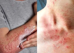 Viêm da dị ứng kiêng gì?