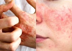 Viêm da tiếp xúc dị ứng vùng mặt, làm thế nào để phòng tránh?