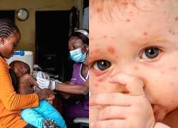 WHO cảnh báo nguy cơ bùng phát dịch sởi tại Anh