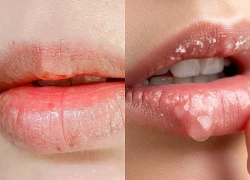Môi khô, bong tróc khi trời vào thu, đừng bỏ qua những thói quen này