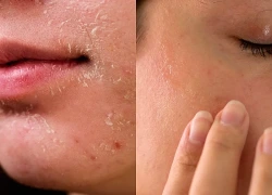 5 bí quyết cải thiện da bong tróc, phục hồi mịn màng mùa thu đông