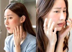 Da nhạy cảm trước gió lạnh: chăm sóc thế nào cho đúng?