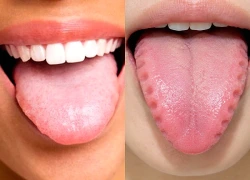 Lưỡi hằn dấu răng cảnh báo điều gì theo y học cổ truyền?