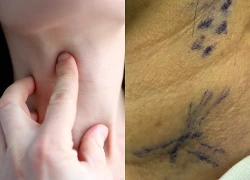 Tái phát ung thư tuyến giáp sau 14 năm vì một sai lầm của người bệnh