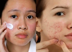 5 cách chăm sóc da sau mụn giúp vùng thâm sạm dần cải thiện