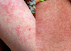 Mỹ đối mặt với đợt bùng phát bệnh sởi nghiêm trọng nhất 35 năm