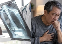 9 dấu hiệu ung thư phổi giai đoạn đầu