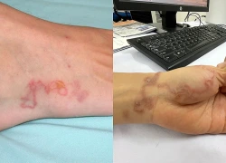 Nghiên cứu quốc tế cảnh báo nguy cơ nhiễm giun móc ở người trưởng thành