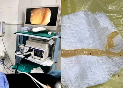 Phát hiện sán dây bò dài 70 cm khi nội soi đại tràng