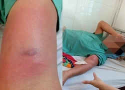 Giun rồng chui dưới da sau nhiều ngày đi rừng uống nước suối