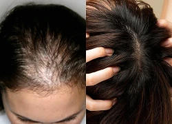Hướng dẫn chăm sóc da đầu khi bị rụng tóc