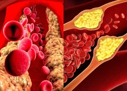 Triglyceride cao gây viêm tụy cấp nguy hiểm đe doạ tính mạng