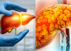 Triển vọng điều trị chứng gan nhiễm mỡ nặng nhờ cơ chế phục hồi đường ruột