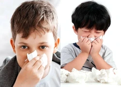 Áp xe hốc mắt ở trẻ: Cảnh giác biến chứng do viêm xoang