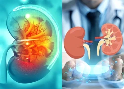 Mỹ 'bật đèn xanh' cho thuốc điều trị bệnh thận hiếm gặp
