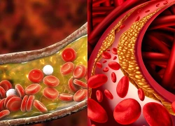 Mách bạn cách giúp giảm cholesterol tự nhiên, bảo vệ sức khỏe tim mạch