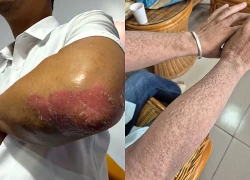 Thuốc sinh học đắt đỏ khiến bệnh nhân vảy nến khó theo đuổi điều trị