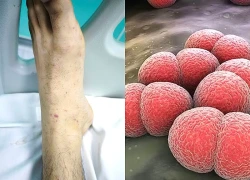 Vì sao bệnh não mô cầu có tỷ lệ mắc thấp nhưng nguy cơ tử vong cao?