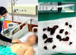 Người đàn ông bị nấm đen xâm lấn não