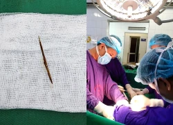 Thủng ruột vì thói quen rất nhiều người Việt mắc