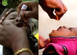 Bùng phát dịch bại liệt tại Malawi