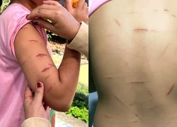 Chủ tịch tỉnh Cà Mau chỉ đạo làm rõ vụ bé gái lớp 5 bị chị họ dùng dao rạch tay