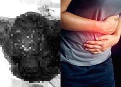 Cụ bà 72 tuổi đau âm ỉ nhiều ngày, bác sĩ sốc khi lấy ra thứ "đáng sợ" bên trong bụng