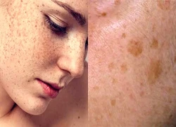 Nhận diện thủ phạm gây đốm đồi mồi trên da