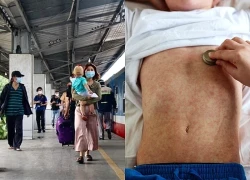 Sắp Tết, cảnh giác với bệnh sởi bùng phát ở trẻ em