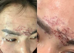 Vụ xăm lên mặt nghi do ghen tuông ở Cà Mau: Truy tố 2 phụ nữ