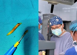 Nam bệnh nhân nhập viện cấp cứu vì xương cá kích thước lớn 'đi lạc' xuống... ruột non