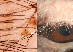 Người phụ nữ 24 tuổi khó chịu ở mí mắt, bác sĩ sốc khi gắp ra thứ 'đáng sợ' chi chít trên mi