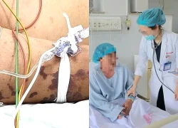 Từ cơn sốt như cảm cúm, người phụ nữ sốc nhiễm trùng, suy đa tạng