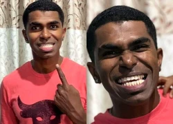 Tưởng mọc răng 'bất thường', chàng trai đi khám và phát hiện mình nắm kỷ lục hiếm có