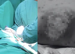 Người đàn ông suýt chết vì... một nốt mụn nhọt