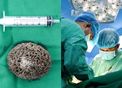 Phẫu thuật lấy viên sỏi bàng quang 'khủng' bằng quả trứng ngỗng