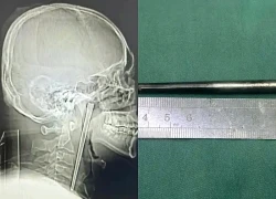 Ăn nhầm chiếc đũa 12cm, người đàn ông Trung Quốc chịu đựng trong 8 năm