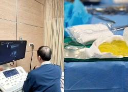 Người phụ nữ tá hỏa vì túi ngực vỡ vụn sau 5 năm dù không có cảm giác đau