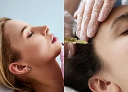 Tiêm botox, filler bao lâu thì 'lên form' đẹp nhất?