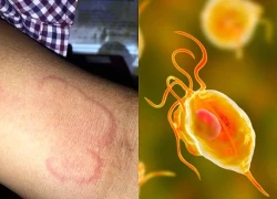 Bệnh ký sinh trùng nhiều người dương tính khi xét nghiệm ở Khánh Hòa nguy hiểm mức nào nếu không điều trị sớm?