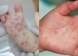Ca tay chân miệng tăng vọt, chuyên gia khuyến cáo 5 nguyên tắc phòng bệnh