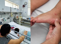 Cảnh báo chủng virus EV71 độc lực cao khiến bệnh tay chân miệng trở nặng nhanh