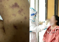 Bé 2 tuổi tử vong do viêm não mô cầu, người thân phải cách ly y tế