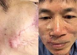 Ung thư biểu mô tế bào đáy tái phát: Khi 'mổ đi mổ lại' vẫn không hết bệnh