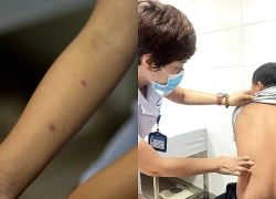 Mới nắng đầu mùa, nhiều người đã mắc bệnh da liễu, bác sĩ chỉ cách phòng tránh